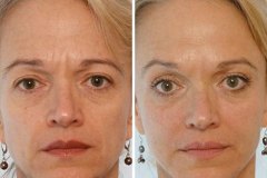 1718756260-botox-9