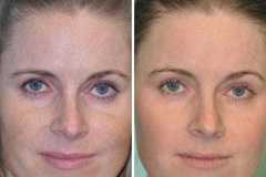 1718914663-laser-skin-resurfacing-2