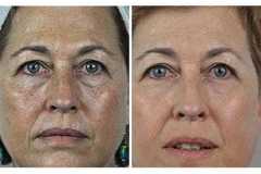 1718914986-laser-skin-resurfacing-3