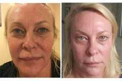 1718915012-laser-skin-resurfacing-5