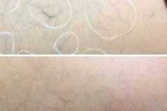 1718915288-laser-vein-removal-1