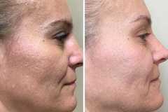 1718756498-microneedling-8