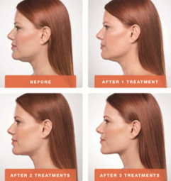 Is Kybella For Me?